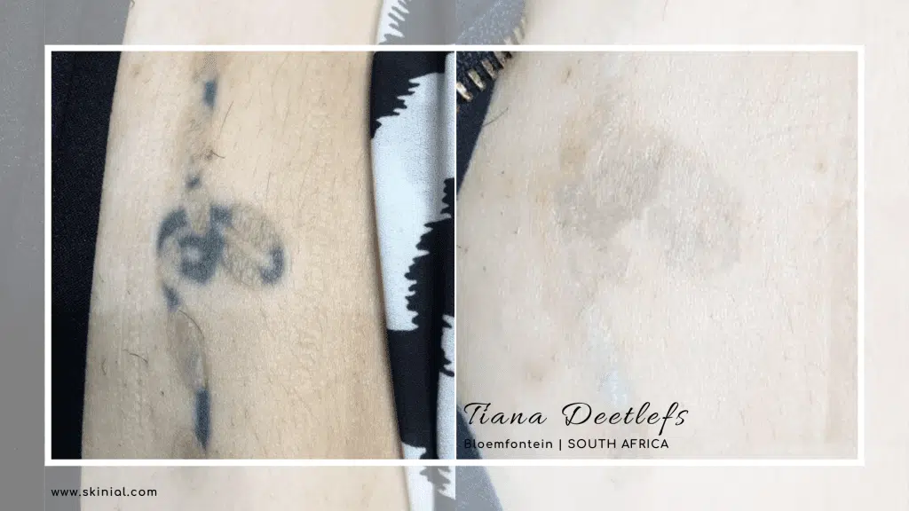 Skinial vs Laser Tattoo Removals 2 tattoo tiana removal progress 2 treatments