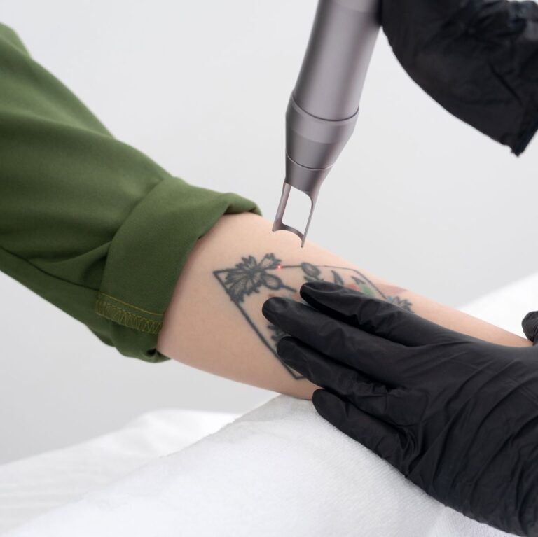 Skinial vs Laser Tattoo Removals | Your Beauty Boudoir
