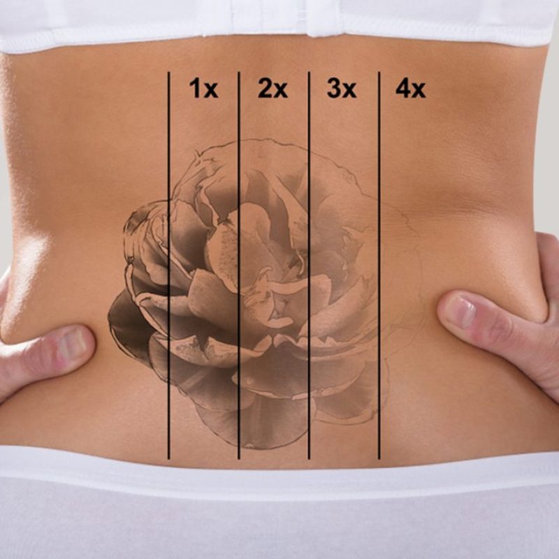 laser-center-tatto-removal laser-center-tatto-removal